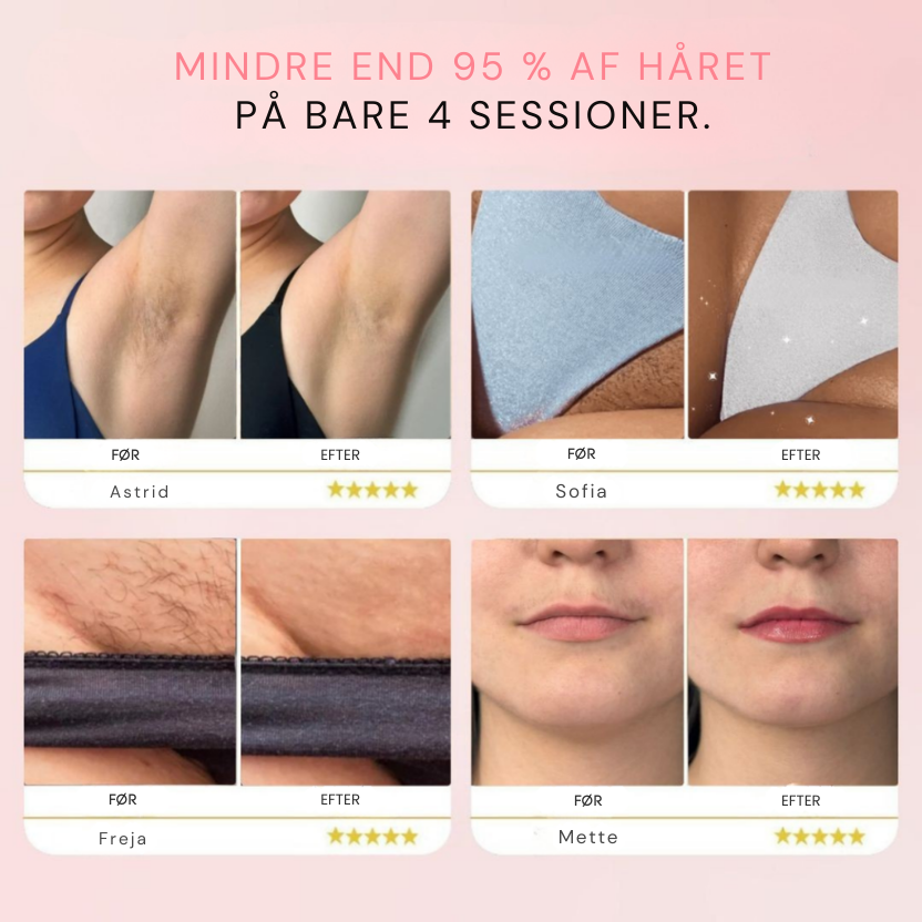 IPL-laserhårfjerner